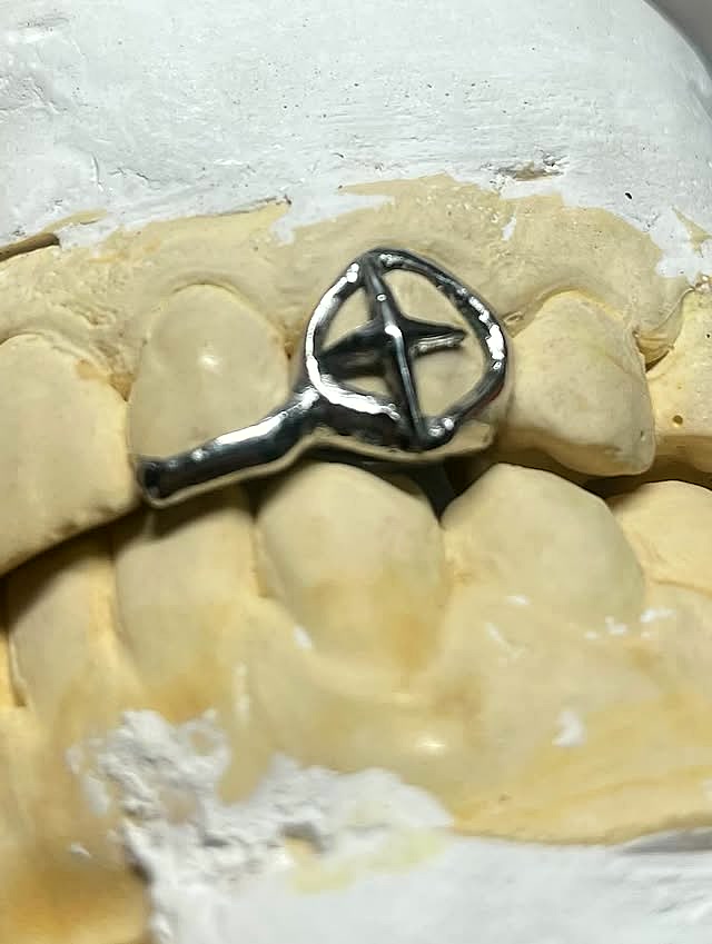 Custom silver star bar tooth piece fitted to a plaster dental model