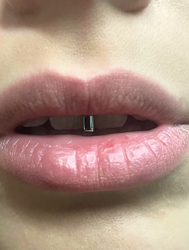 Minimal single-tooth silver bar cap fitted on a client in Madrid