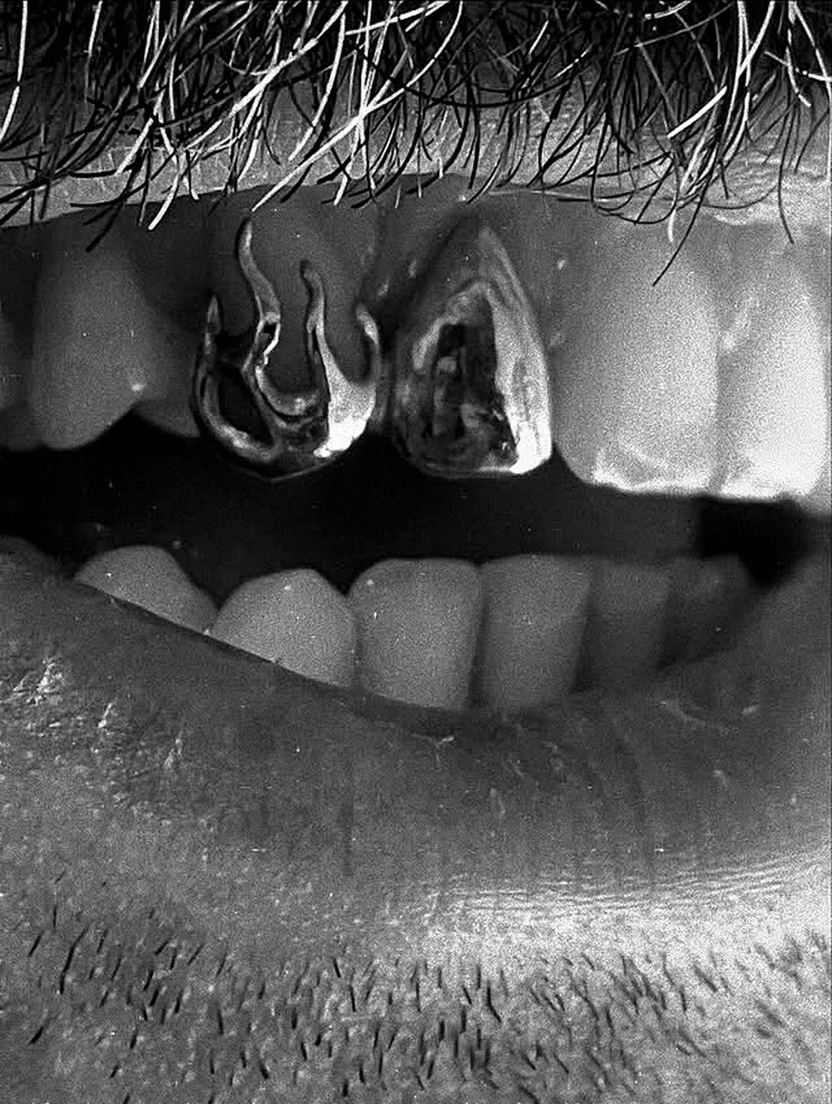 Black and white macro of flame-cut custom silver grillz caps