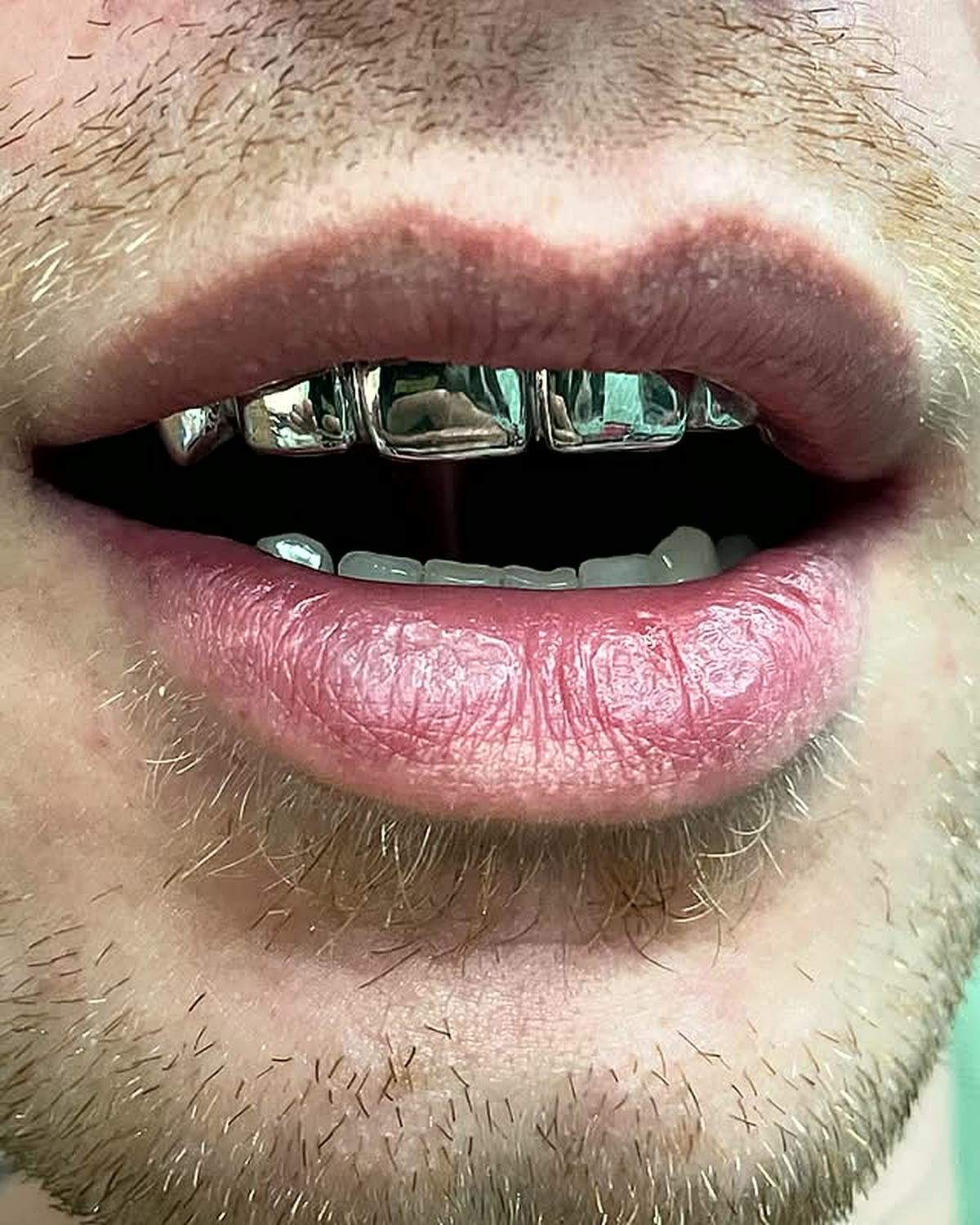 Custom polished silver grillz top row fitted on a client in Madrid